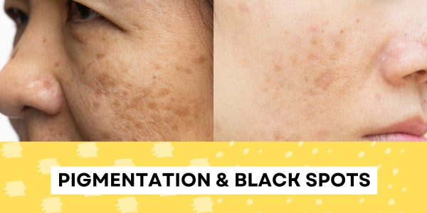 Pigmentation & Black Spots – The Cura Team®
